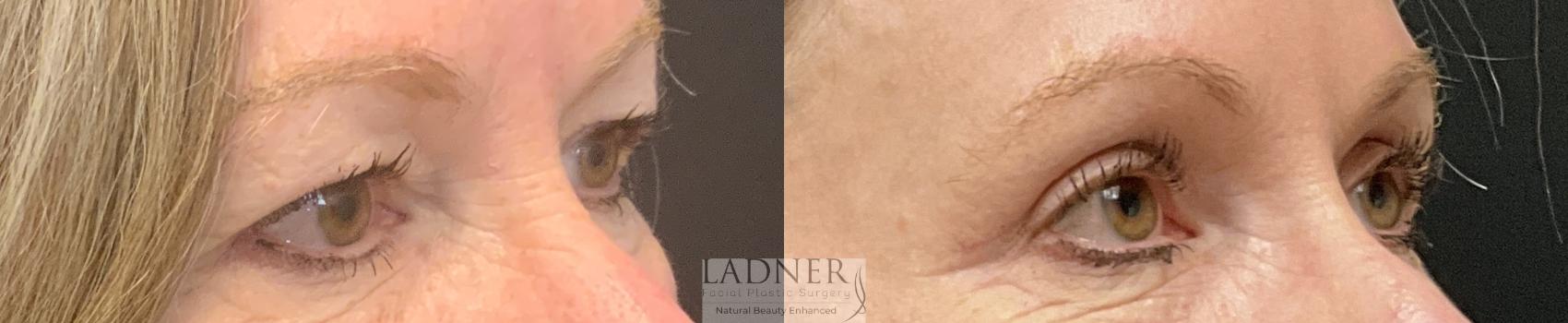Eyelid Surgery (blepharoplasty) Case 166 Before & After Right Oblique | Denver, CO | Ladner Facial Plastic Surgery