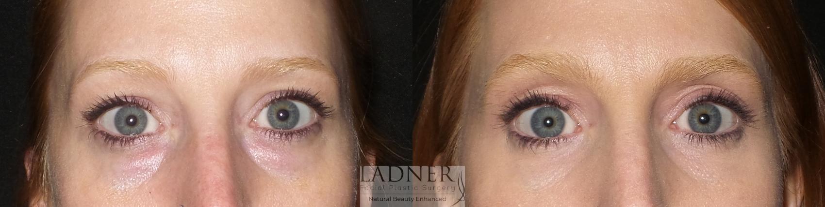 Eyelid Surgery (blepharoplasty) Case 175 Before & After Front | Denver, CO | Ladner Facial Plastic Surgery