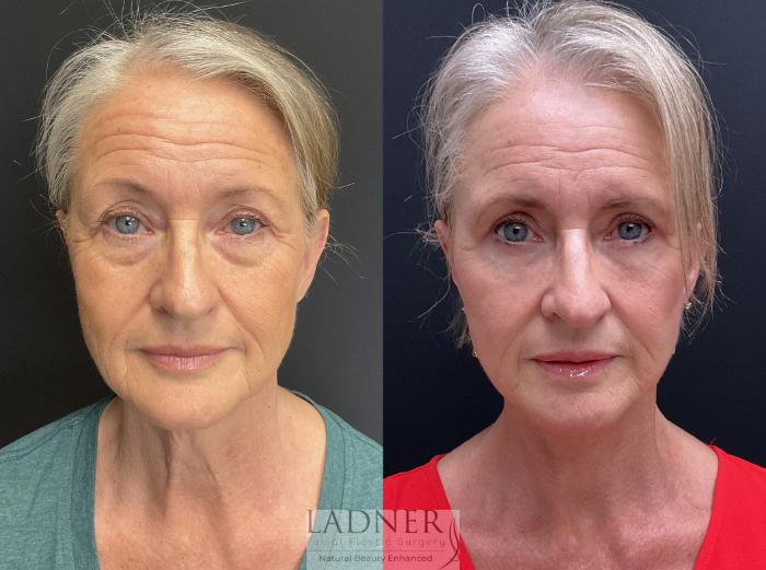 Facial Fat Transfer Case 189 Before & After Front | Denver, CO | Ladner Facial Plastic Surgery