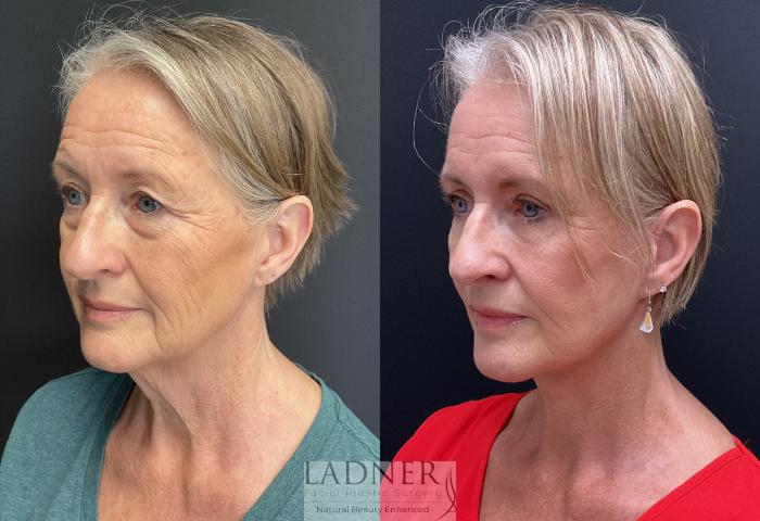 Facelift / Neck Lift Case 189 Before & After Left Oblique | Denver, CO | Ladner Facial Plastic Surgery