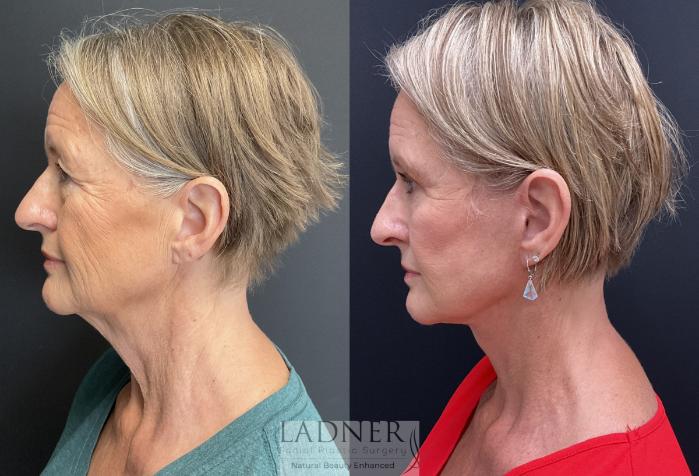 Facelift / Neck Lift Case 189 Before & After Left Side | Denver, CO | Ladner Facial Plastic Surgery