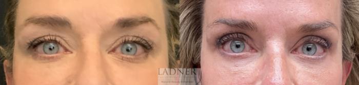 Eyelid Surgery (blepharoplasty) Case 196 Before & After Front | Denver, CO | Ladner Facial Plastic Surgery