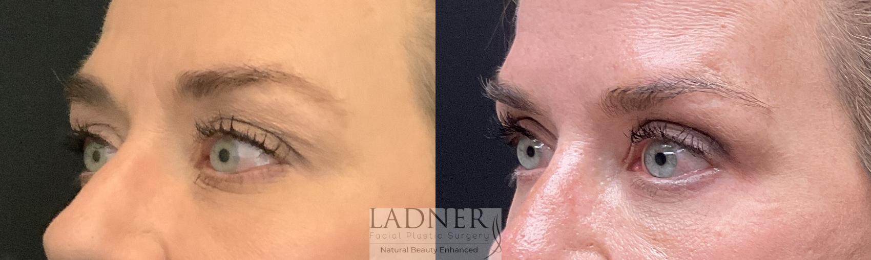 Eyelid Surgery (blepharoplasty) Case 196 Before & After Left Oblique | Denver, CO | Ladner Facial Plastic Surgery