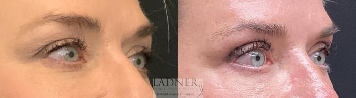Eyelid Surgery (blepharoplasty) Case 196 Before & After Right Oblique | Denver, CO | Ladner Facial Plastic Surgery