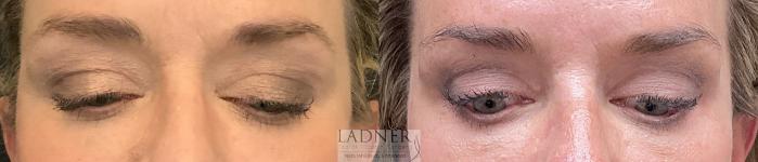 Eyelid Surgery (blepharoplasty) Case 196 Before & After Upper lids | Denver, CO | Ladner Facial Plastic Surgery