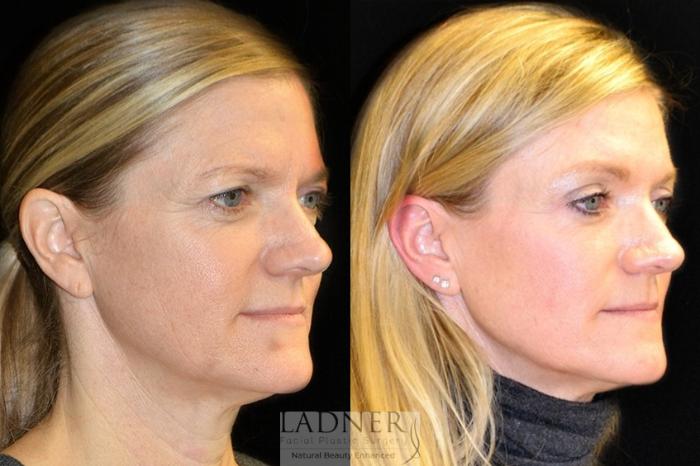 Brow Lift / Forehead Lift Case 20 Before & After Right Oblique | Denver, CO | Ladner Facial Plastic Surgery