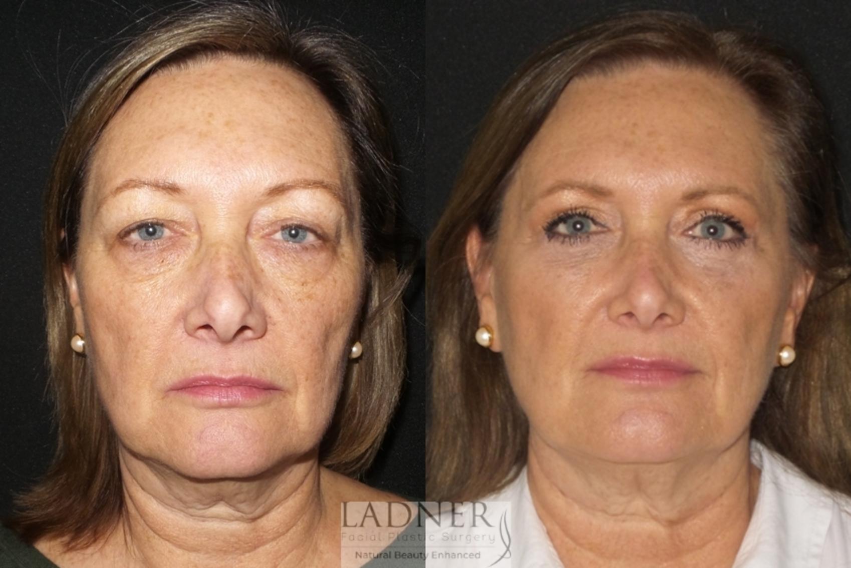 Eyelid Surgery (blepharoplasty) Case 21 Before & After Front | Denver, CO | Ladner Facial Plastic Surgery