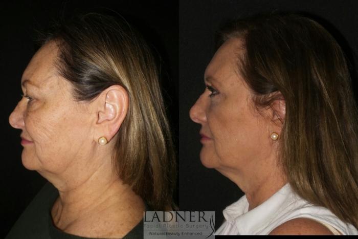 Eyelid Surgery (blepharoplasty) Case 21 Before & After Left Side | Denver, CO | Ladner Facial Plastic Surgery