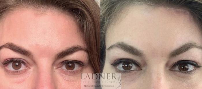 Eyelid Surgery Blepharoplasty Before And After Photo Gallery Denver Co Ladner Facial 1167