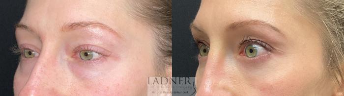 Eyelid Surgery (blepharoplasty) Case 227 Before & After Left Oblique | Denver, CO | Ladner Facial Plastic Surgery