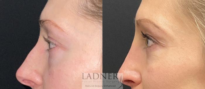 Eyelid Surgery (blepharoplasty) Case 227 Before & After Left Side | Denver, CO | Ladner Facial Plastic Surgery