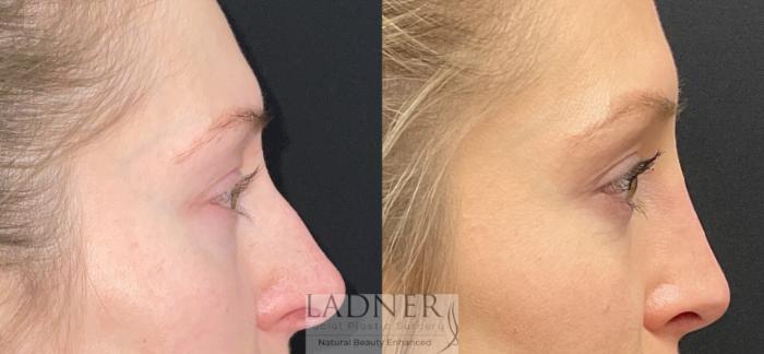 Eyelid Surgery (blepharoplasty) Case 227 Before & After Right Side | Denver, CO | Ladner Facial Plastic Surgery