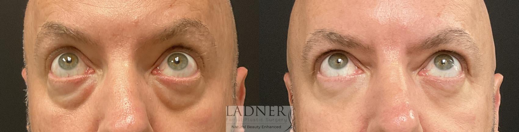 Eyelid Surgery (blepharoplasty) Case 229 Before & After Front Looking Up  | Denver, CO | Ladner Facial Plastic Surgery