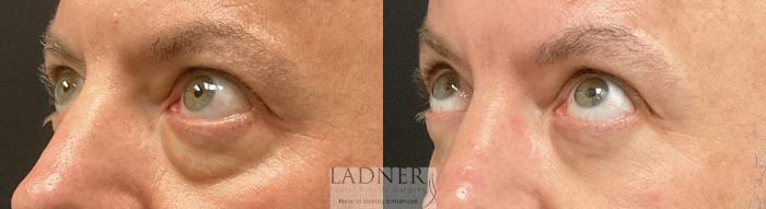 Eyelid Surgery (blepharoplasty) Case 229 Before & After Left Oblique Looking Up  | Denver, CO | Ladner Facial Plastic Surgery