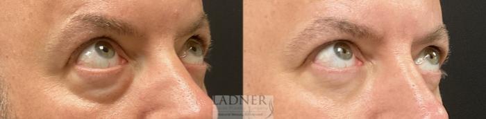 Eyelid Surgery (blepharoplasty) Case 229 Before & After Right Oblique Looking Up  | Denver, CO | Ladner Facial Plastic Surgery