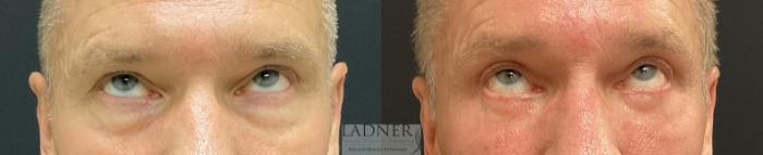 Eyelid Surgery (blepharoplasty) Case 231 Before & After Front Looking Up  | Denver, CO | Ladner Facial Plastic Surgery