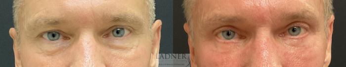 Eyelid Surgery (blepharoplasty) Case 231 Before & After Front | Denver, CO | Ladner Facial Plastic Surgery