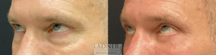 Eyelid Surgery (blepharoplasty) Case 231 Before & After Left Oblique Looking Up  | Denver, CO | Ladner Facial Plastic Surgery