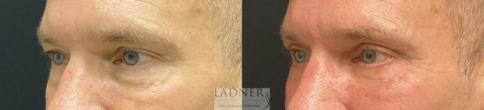 Eyelid Surgery (blepharoplasty) Case 231 Before & After Left Oblique | Denver, CO | Ladner Facial Plastic Surgery