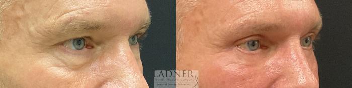 Eyelid Surgery (blepharoplasty) Case 231 Before & After Right Oblique | Denver, CO | Ladner Facial Plastic Surgery