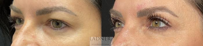 Eyelid Surgery (blepharoplasty) Case 234 Before & After Left Oblique | Denver, CO | Ladner Facial Plastic Surgery