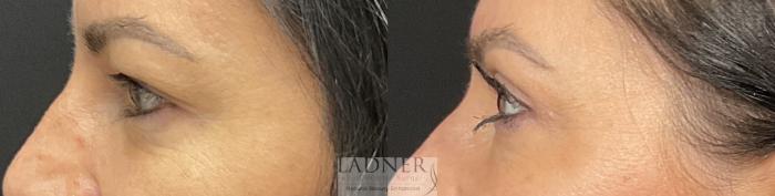 Eyelid Surgery (blepharoplasty) Case 234 Before & After Left Side | Denver, CO | Ladner Facial Plastic Surgery