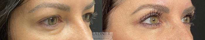 Eyelid Surgery (blepharoplasty) Case 234 Before & After Right Oblique | Denver, CO | Ladner Facial Plastic Surgery