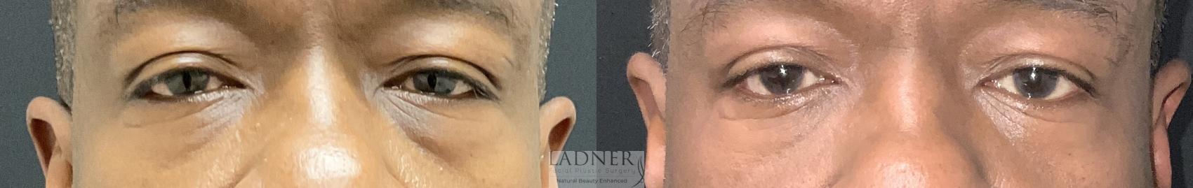 Eyelid Surgery (blepharoplasty) Case 235 Before & After Front | Denver, CO | Ladner Facial Plastic Surgery