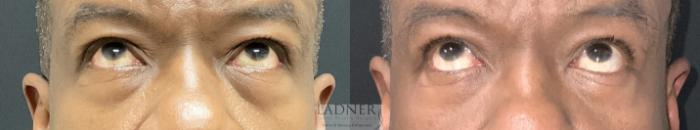Eyelid Surgery (blepharoplasty) Case 235 Before & After Front Looking Up  | Denver, CO | Ladner Facial Plastic Surgery