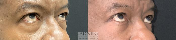 Eyelid Surgery (blepharoplasty) Case 235 Before & After Right Oblique Looking Up  | Denver, CO | Ladner Facial Plastic Surgery