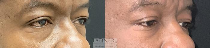 Eyelid Surgery (blepharoplasty) Case 235 Before & After Right Oblique | Denver, CO | Ladner Facial Plastic Surgery