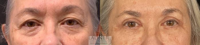Eyelid Surgery (blepharoplasty) Case 239 Before & After Front | Denver, CO | Ladner Facial Plastic Surgery