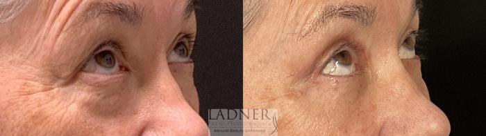 Eyelid Surgery (blepharoplasty) Case 239 Before & After Right oblique looking up  | Denver, CO | Ladner Facial Plastic Surgery