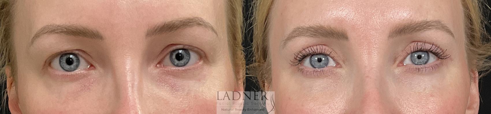 Eyelid Surgery (blepharoplasty) Case 244 Before & After Front | Denver, CO | Ladner Facial Plastic Surgery