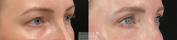 Eyelid Surgery (blepharoplasty) Case 244 Before & After Right Oblique | Denver, CO | Ladner Facial Plastic Surgery