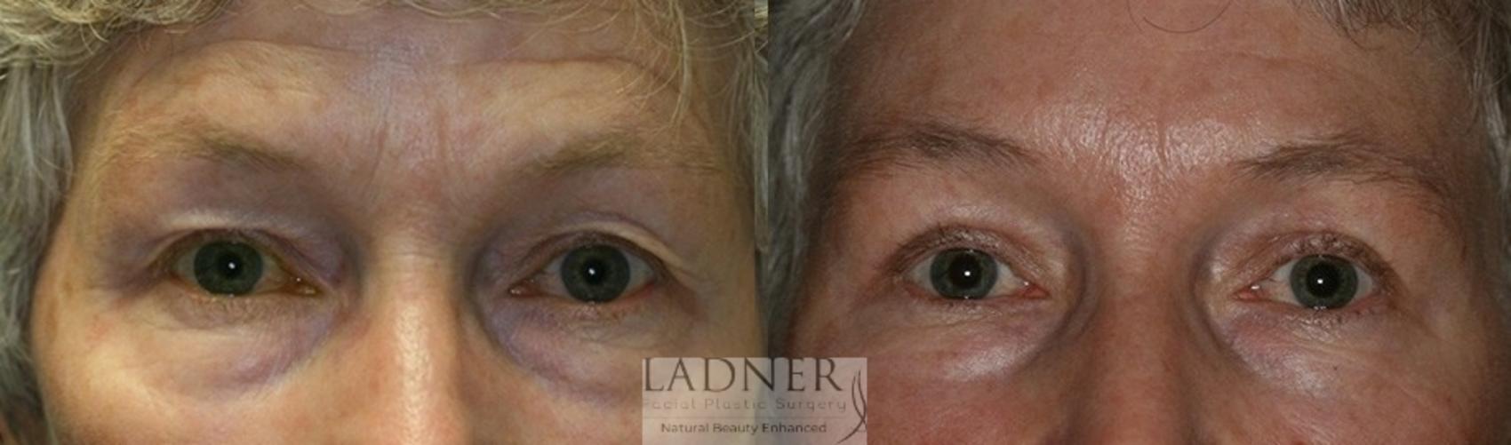 Brow Lift / Forehead Lift Case 49 Before & After Front | Denver, CO | Ladner Facial Plastic Surgery