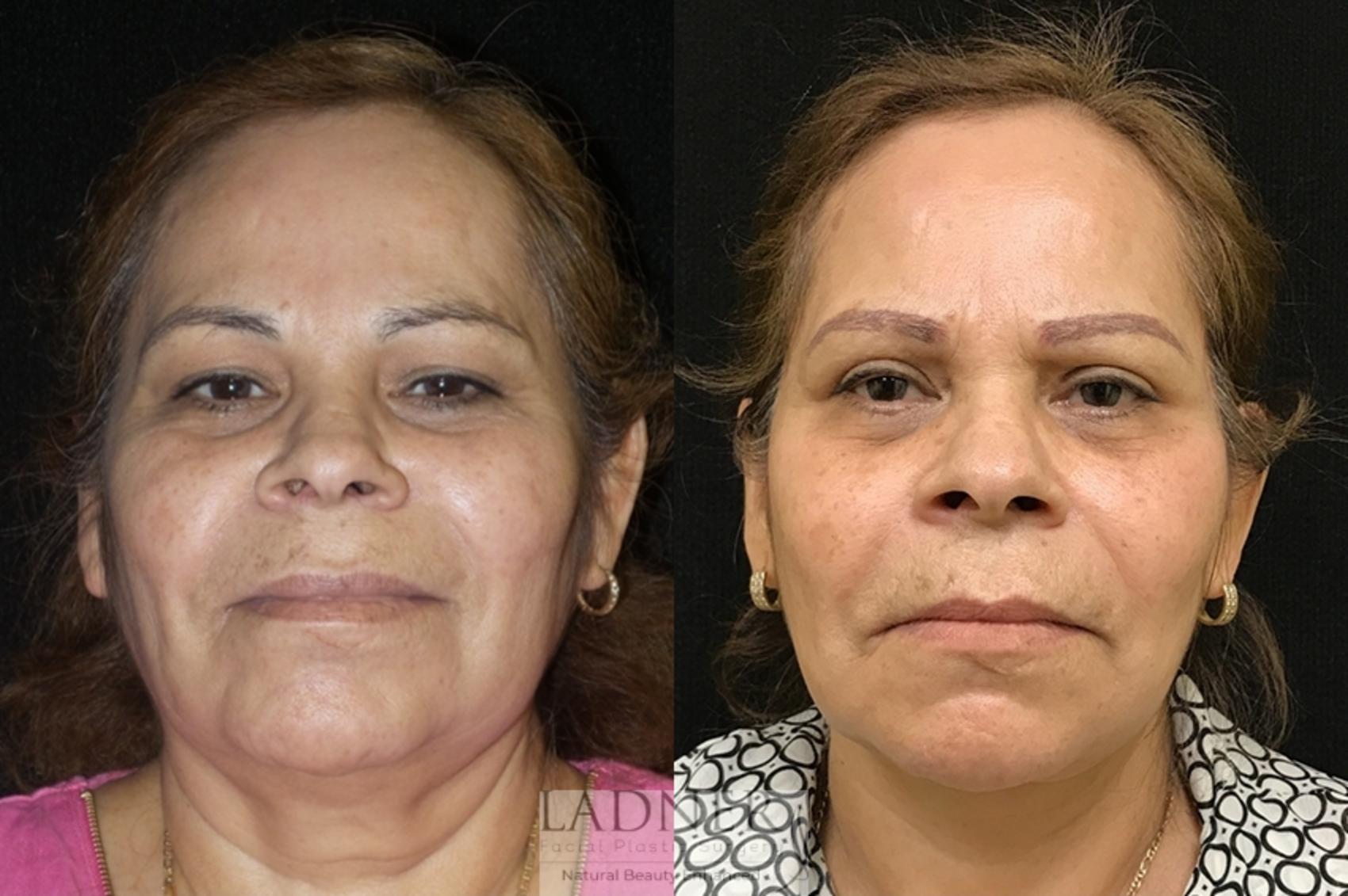 Eyelid Surgery (blepharoplasty) Case 53 Before & After Front | Denver, CO | Ladner Facial Plastic Surgery