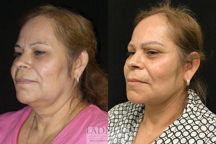 Facial Rejuvenation Case 53 Before & After Left Oblique | Denver, CO | Ladner Facial Plastic Surgery