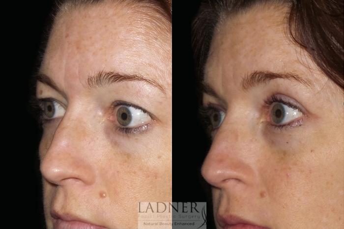Eyelid Surgery (blepharoplasty) Case 54 Before & After Left Oblique | Denver, CO | Ladner Facial Plastic Surgery