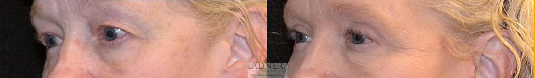 Eyelid Surgery (blepharoplasty) Case 55 Before & After Left Oblique | Denver, CO | Ladner Facial Plastic Surgery