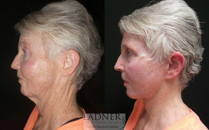 Before: Facelift, Submental liposuction
