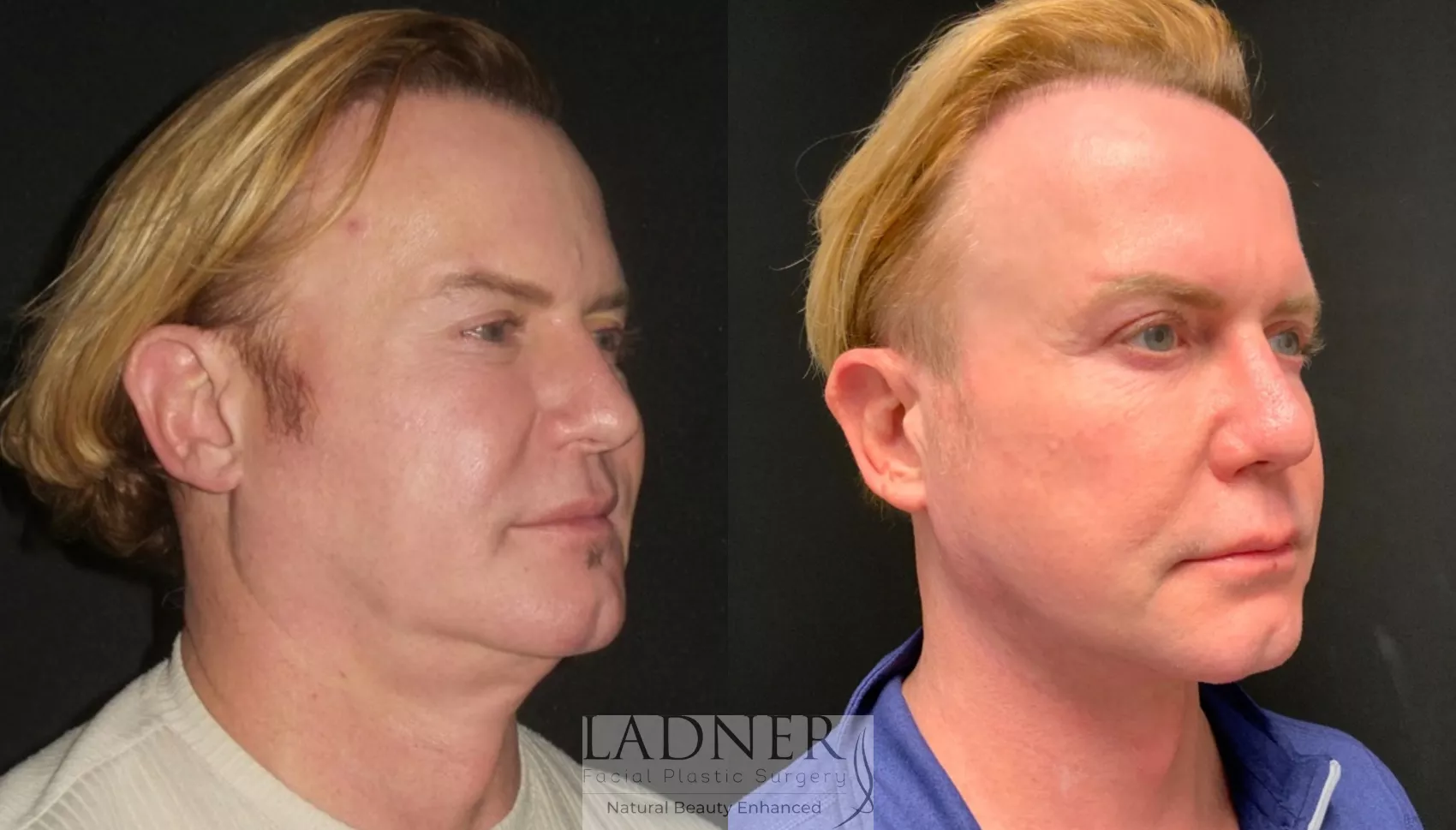 Facelift & Neck Lift in Denver, CO  Ladner Facial Plastic Surgery: Keith  Ladner, MD