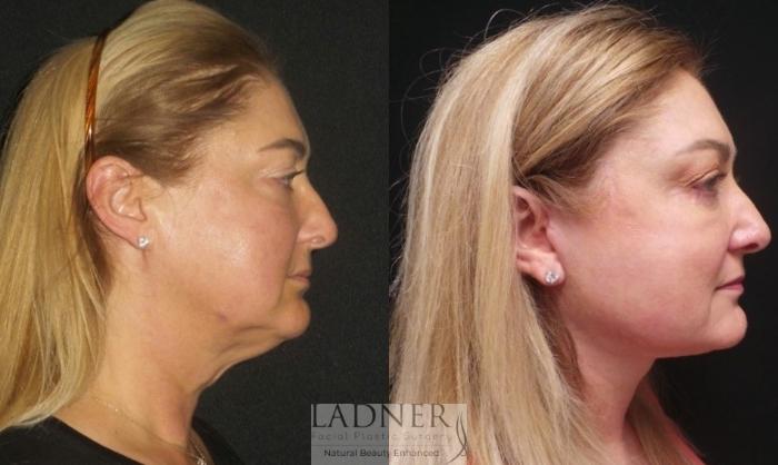Before: Facelift, Submental liposuction