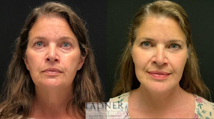 Facelift / Neck Lift Case 112 Before & After Front | Denver, CO | Ladner Facial Plastic Surgery