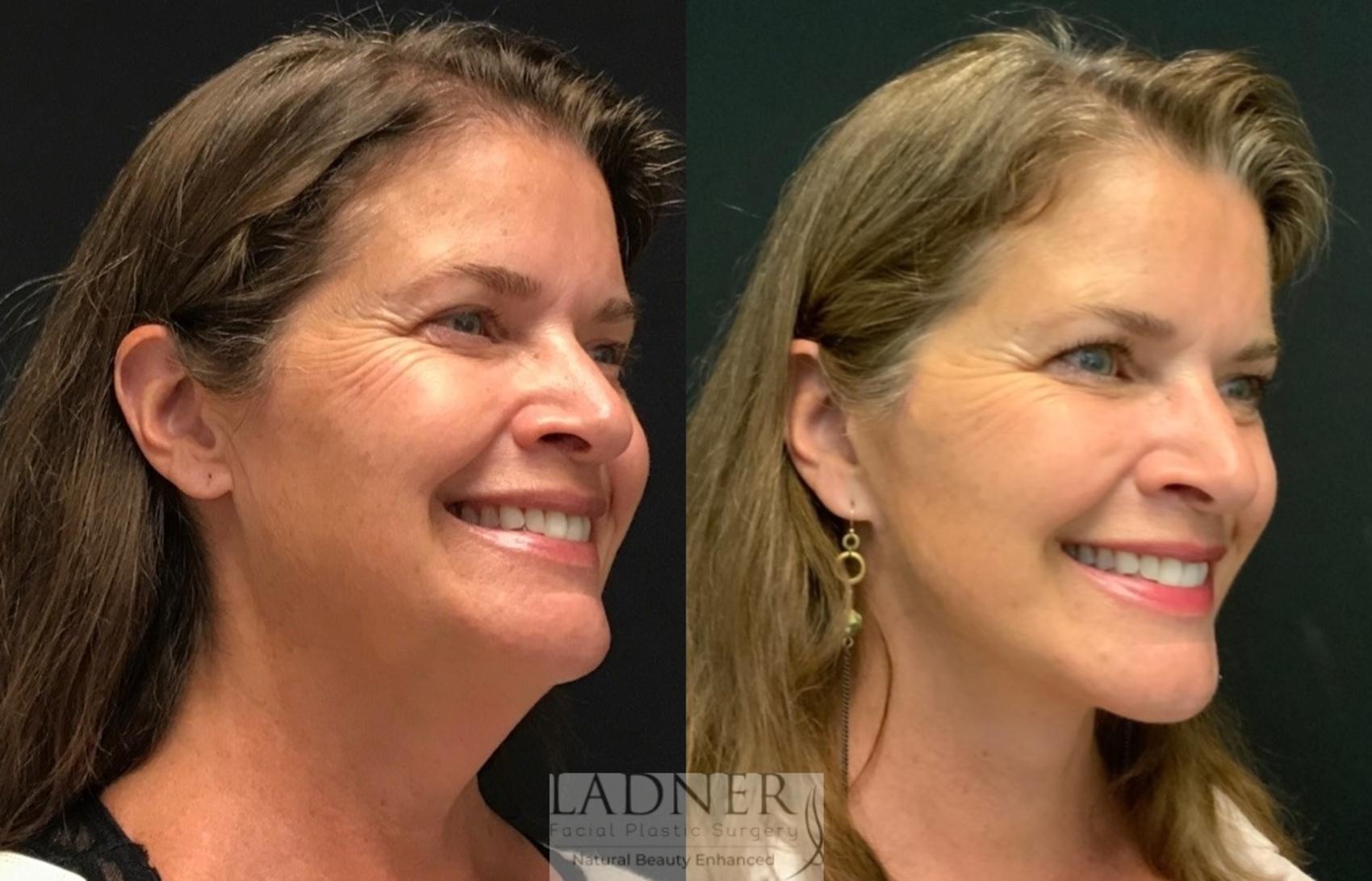 Facelift Neck Lift Before And After Pictures Case 112 Denver Co Ladner Facial Plastic Surgery 