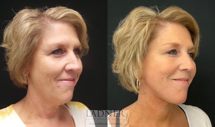 Before: Lower Face Lift with Liposuction & Platysmaplasty