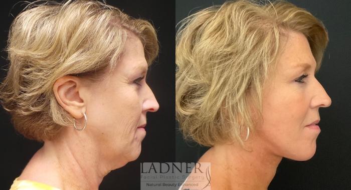 Before: Lower Facelift with Submental Liposuction & Platysmaplasty