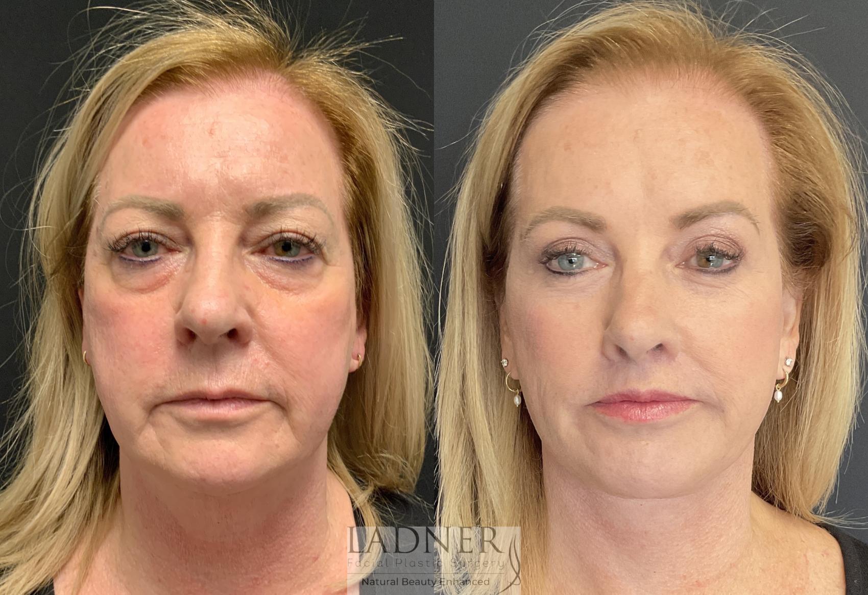 Brow Lift / Forehead Lift Case 123 Before & After Front | Denver, CO | Ladner Facial Plastic Surgery