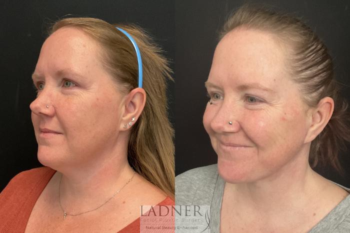 Facial Rejuvenation Case 137 Before & After Left Side | Denver, CO | Ladner Facial Plastic Surgery
