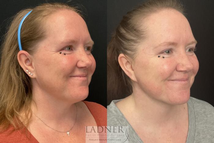 Facial Rejuvenation Case 137 Before & After Right Side | Denver, CO | Ladner Facial Plastic Surgery
